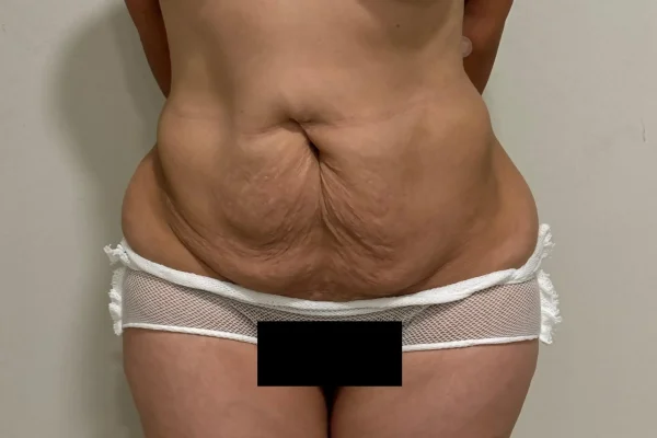 Abdomen Flácido