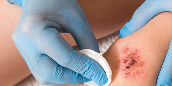 Heridas